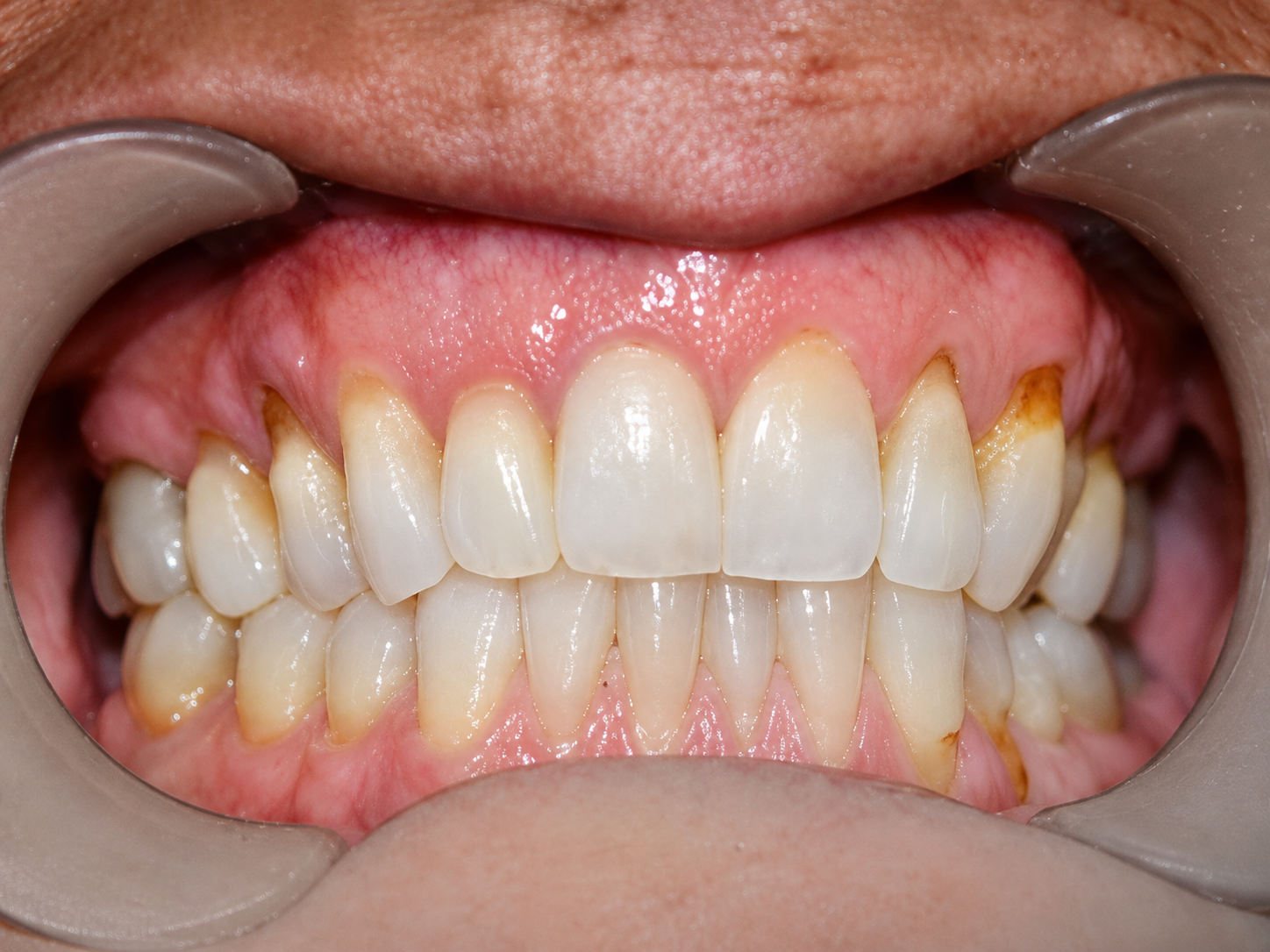 Janell before clear aligner treatment