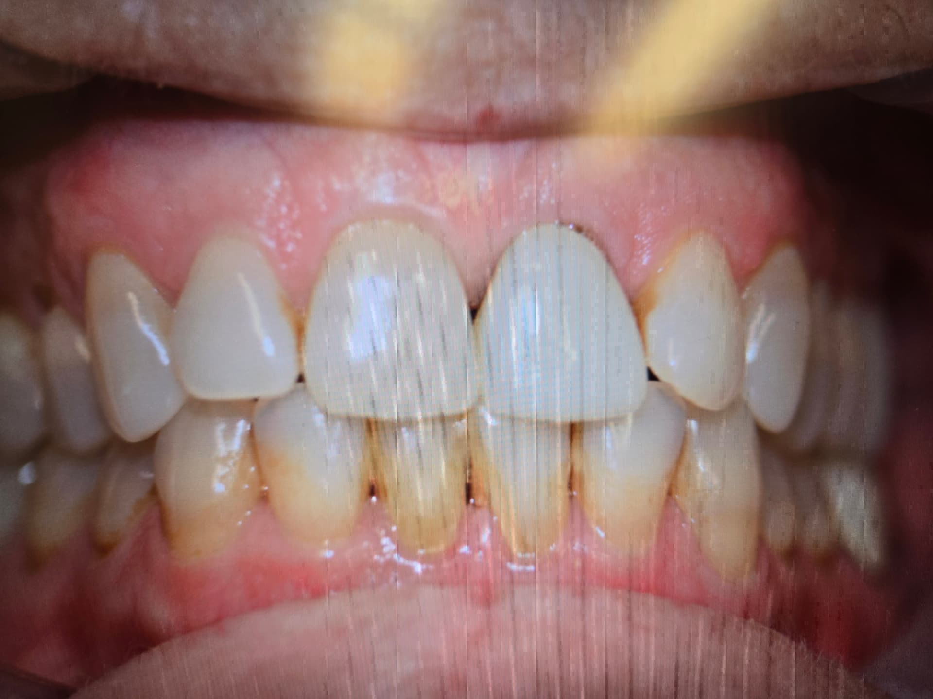 Leslie before clear aligner treatment