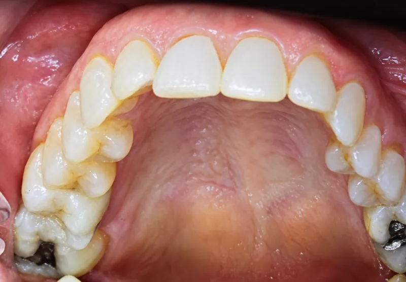 Leslie after clear aligner treatment