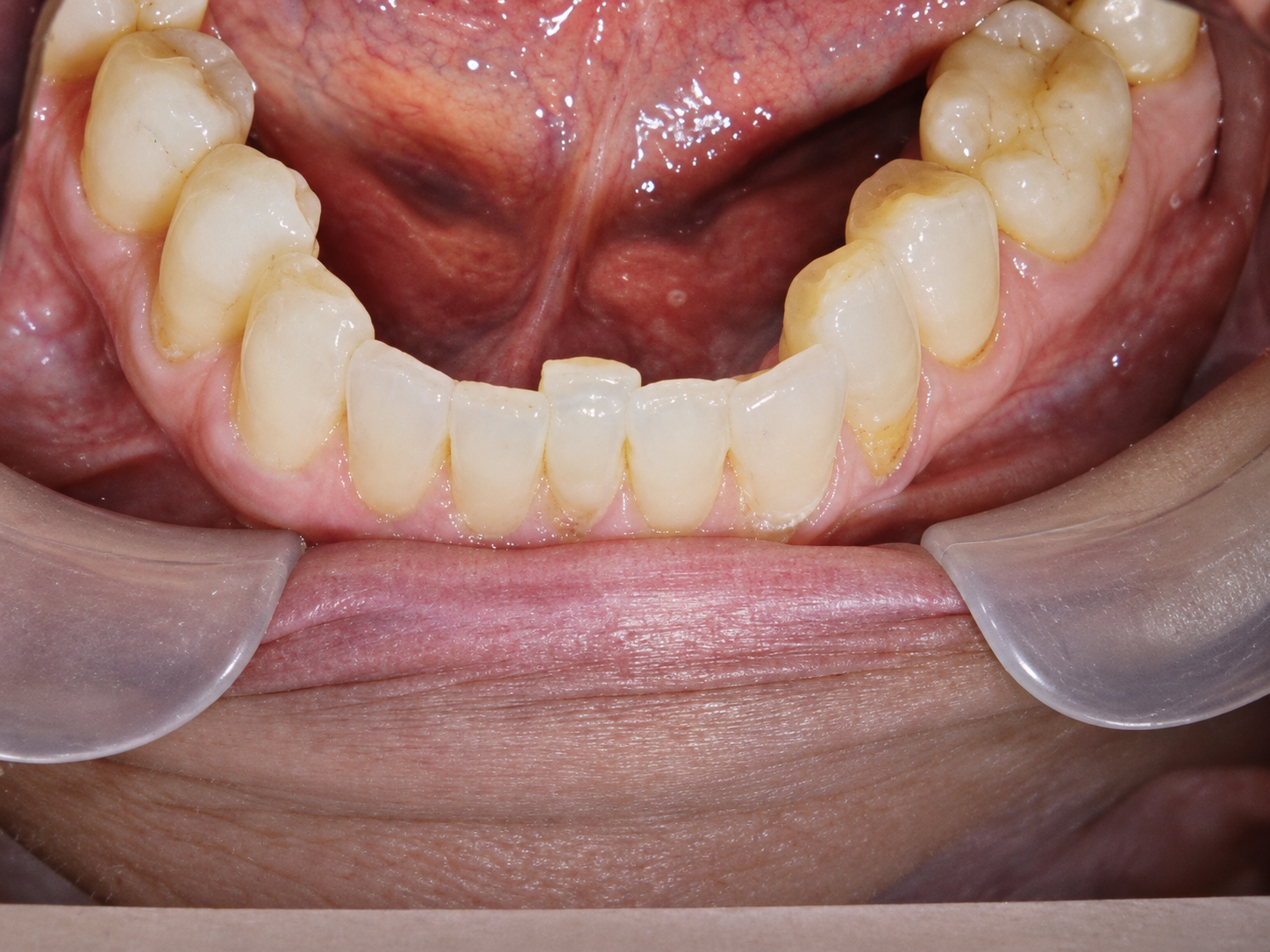 Janell before clear aligner treatment