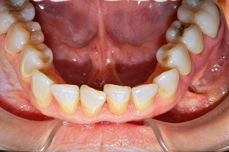 Leslie before clear aligner treatment